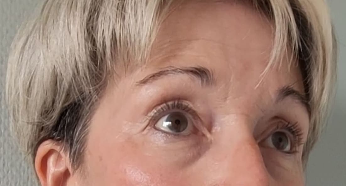 Disparition des rides après traitement